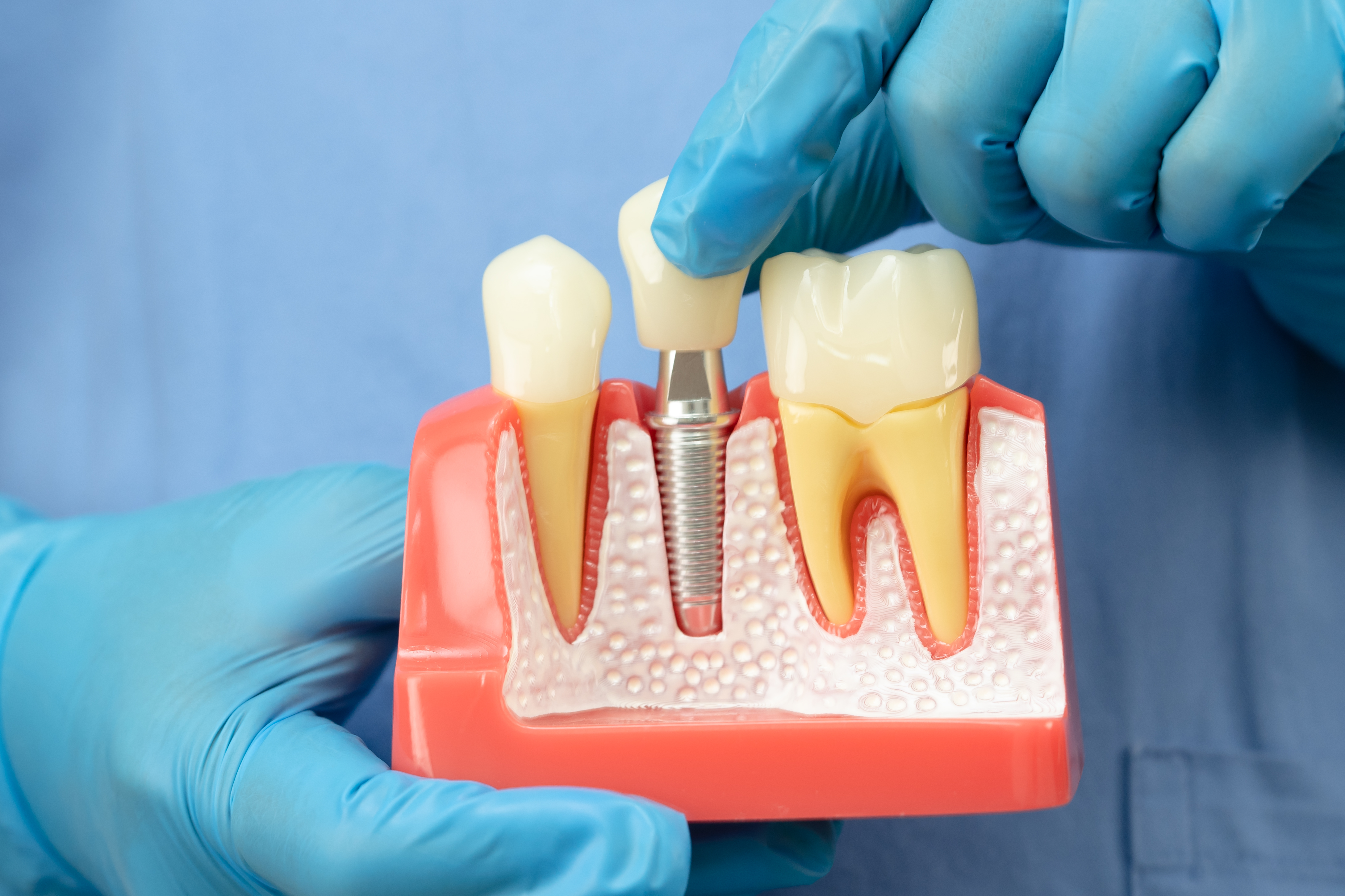 Root Canal Treatment